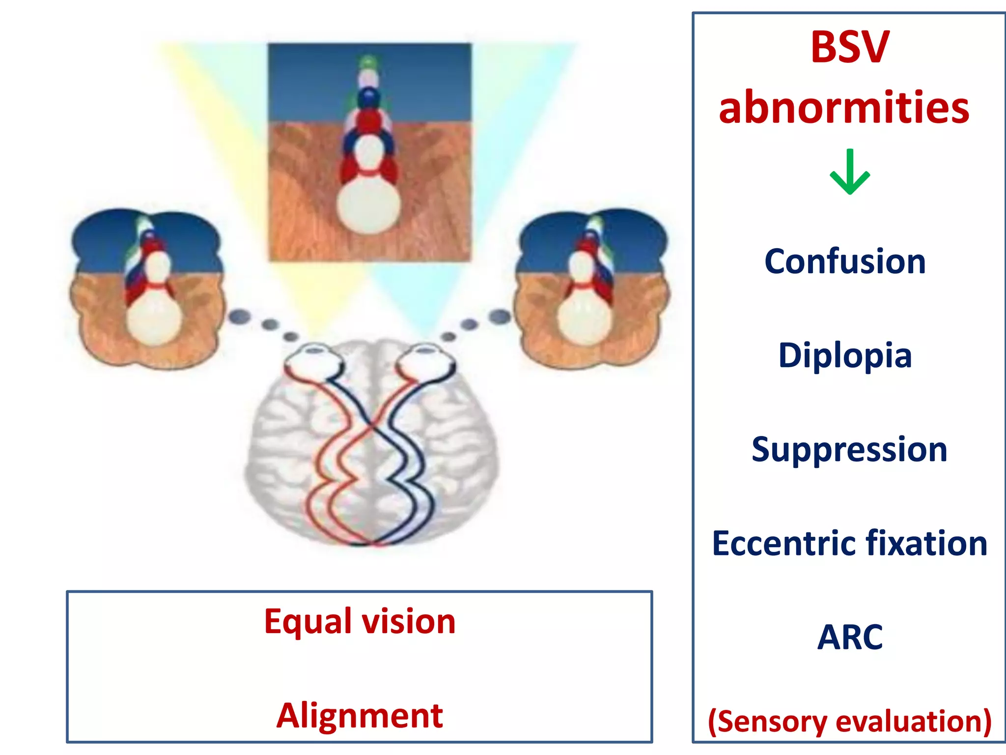 BSV
abnormities
↓
Confusion
Diplopia
Suppression
Eccentric fixation
ARC
(Sensory evaluation)
Equal vision
Alignment
 