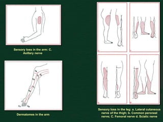 Sensory loss in the arm: C.
Axillary nerve
Dermatomes in the arm
Sensory loss in the leg: a. Lateral cutaneous
nerve of the thigh; b. Common peroneal
nerve; C. Femoral nerve d. Sciatic nerve
 