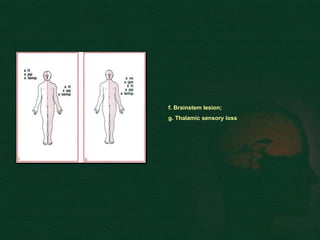 f. Brainstem lesion;
g. Thalamic sensory loss
 