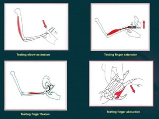 Testing elbow extension Testing finger extension
Testing finger flexion
Testing finger abduction
 