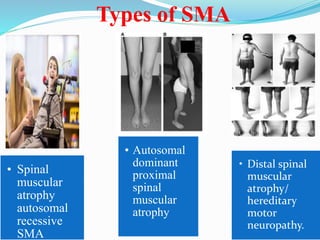 Types of SMA
• Spinal
muscular
atrophy
autosomal
recessive
SMA
• Autosomal
dominant
proximal
spinal
muscular
atrophy
• Distal spinal
muscular
atrophy/
hereditary
motor
neuropathy.
 