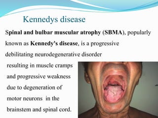 Kennedys disease
Spinal and bulbar muscular atrophy (SBMA), popularly
known as Kennedy's disease, is a progressive
debilitating neurodegenerative disorder
resulting in muscle cramps
and progressive weakness
due to degeneration of
motor neurons in the
brainstem and spinal cord.
 