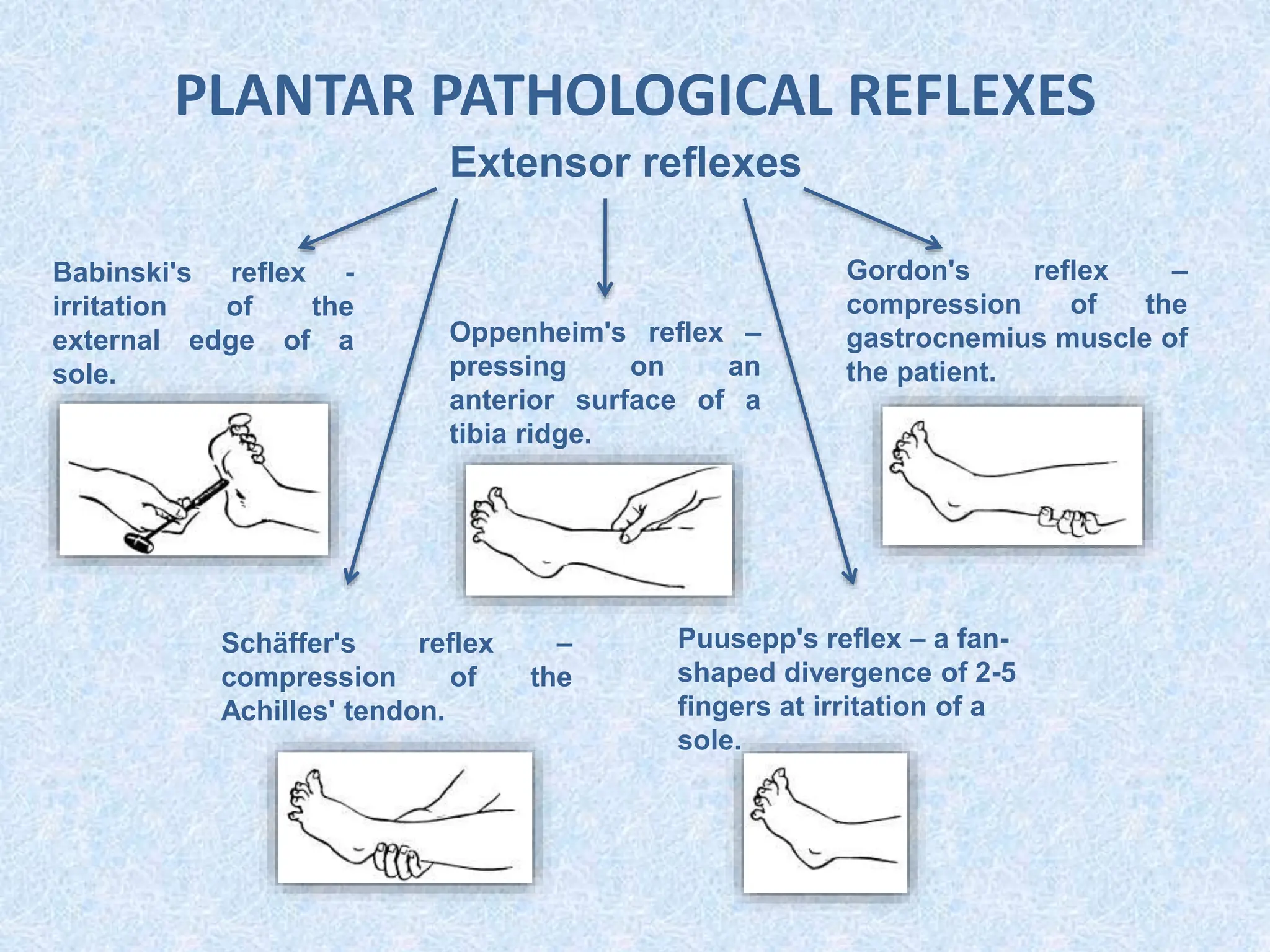 PLANTAR PATHOLOGICAL REFLEXES
Extensor reflexes
Babinski's reflex -
irritation of the
external edge of a
sole.
Oppenheim's reflex –
pressing on an
anterior surface of a
tibia ridge.
Gordon's reflex –
compression of the
gastrocnemius muscle of
the patient.
Schäffer's reflex –
compression of the
Achilles' tendon.
Puusepp's reflex – a fan-
shaped divergence of 2-5
fingers at irritation of a
sole.
 