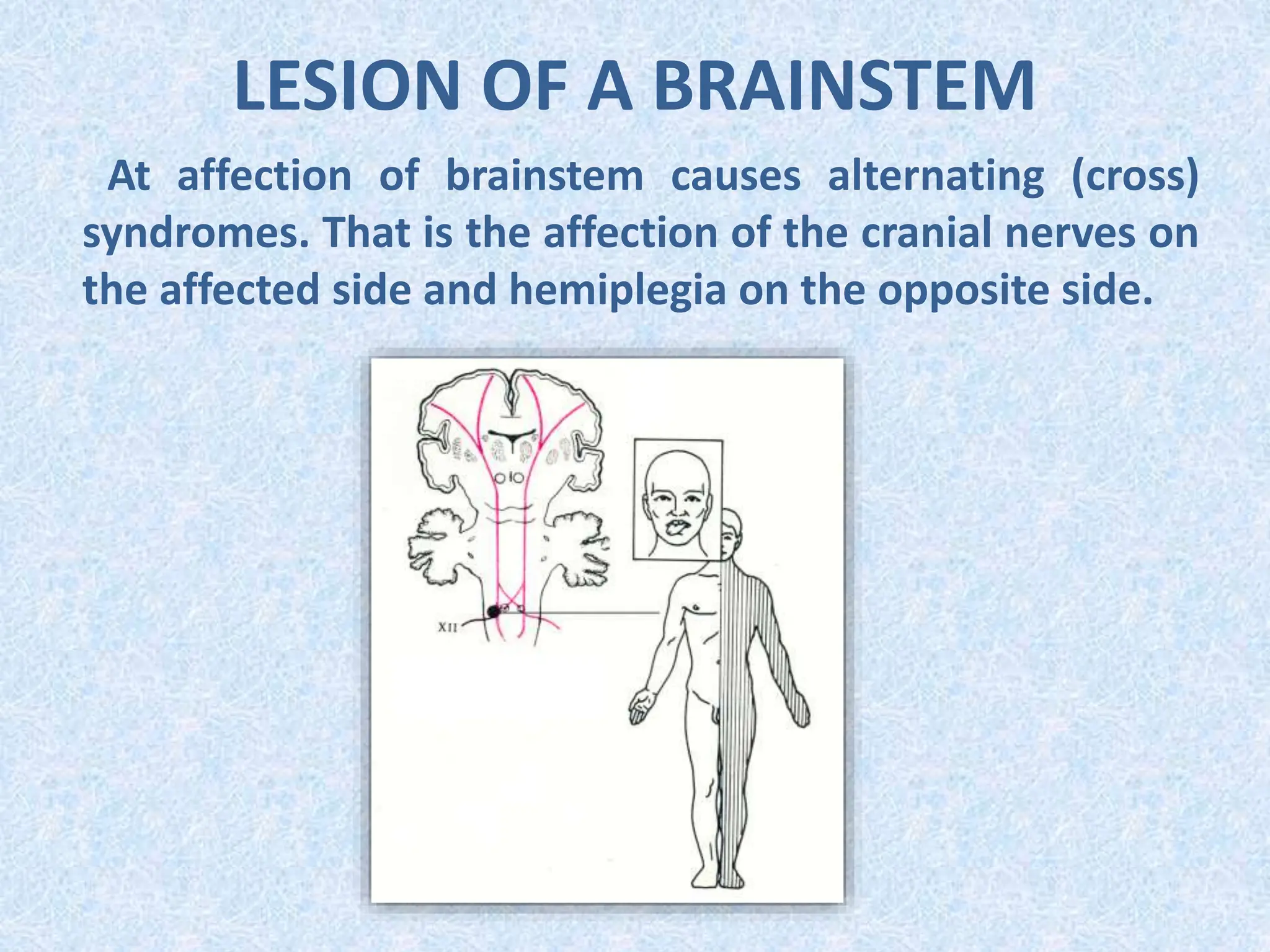 LESION OF A BRAINSTEM
At affection of brainstem causes alternating (cross)
syndromes. That is the affection of the cranial nerves on
the affected side and hemiplegia on the opposite side.
 