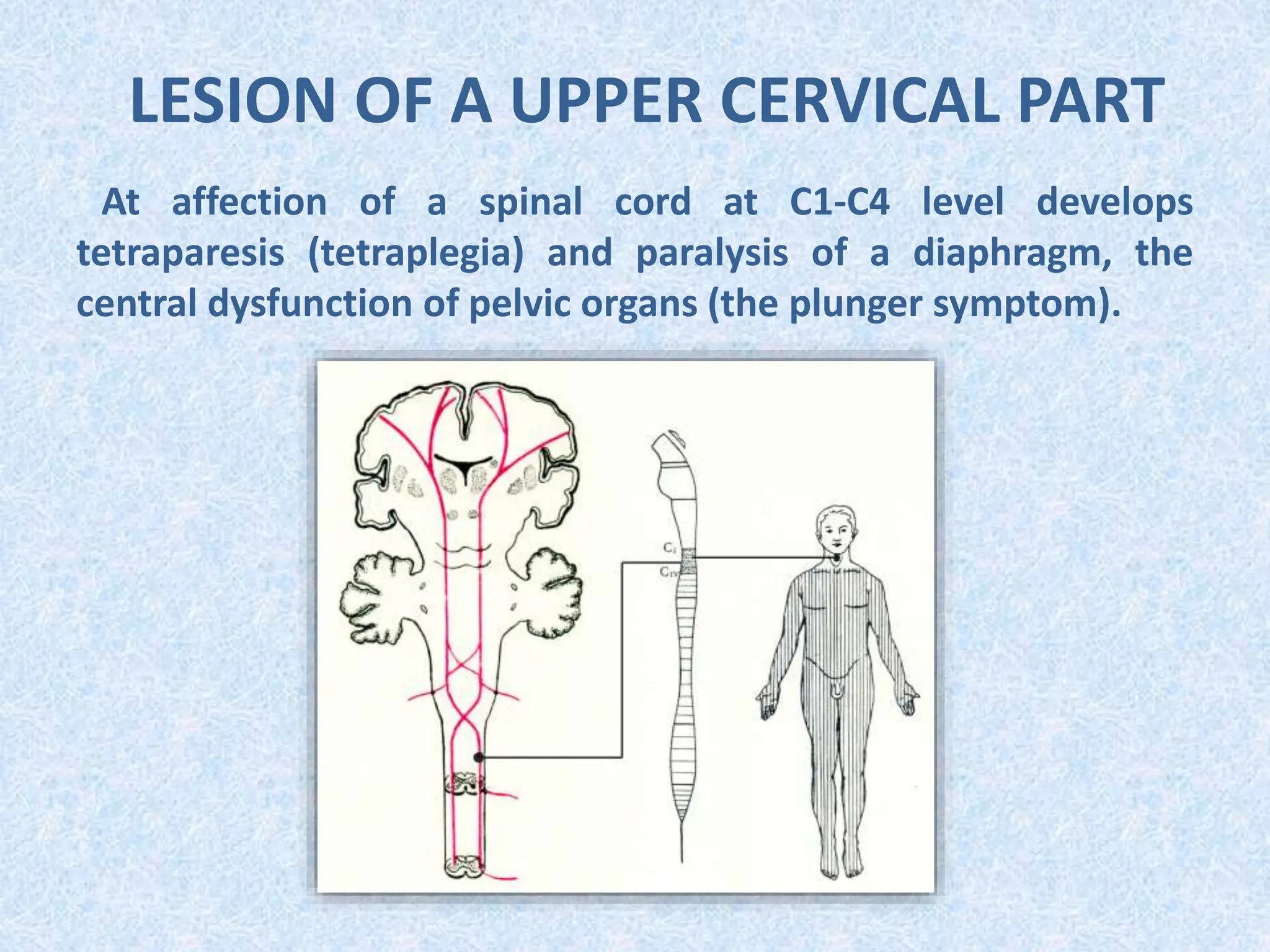 LESION OF A UPPER CERVICAL PART
At affection of a spinal cord at С1-С4 level develops
tetraparesis (tetraplegia) and paralysis of a diaphragm, the
central dysfunction of pelvic organs (the plunger symptom).
 