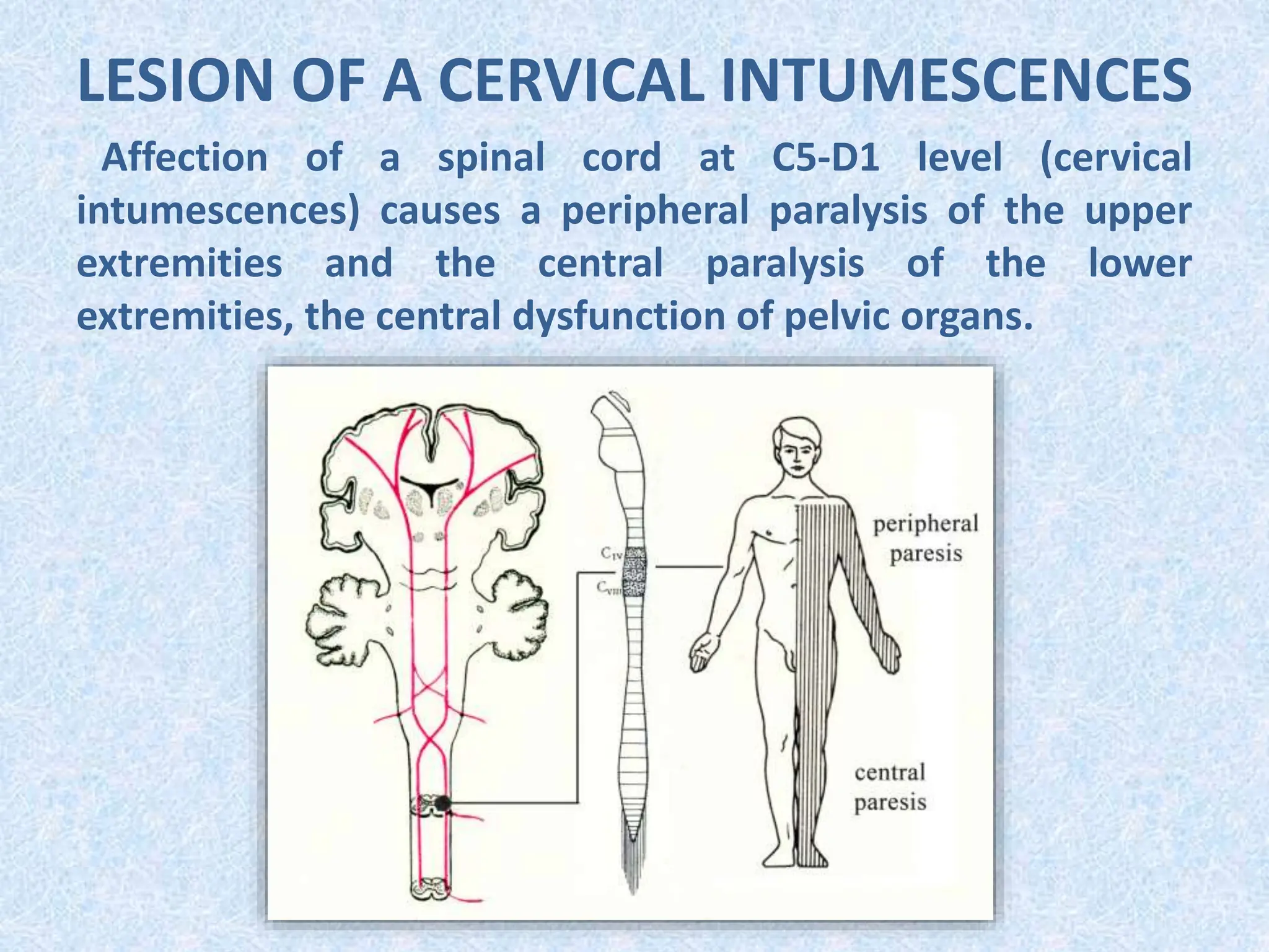 LESION OF A CERVICAL INTUMESCENCES
Affection of a spinal cord at С5-D1 level (cervical
intumescences) causes a peripheral paralysis of the upper
extremities and the central paralysis of the lower
extremities, the central dysfunction of pelvic organs.
 