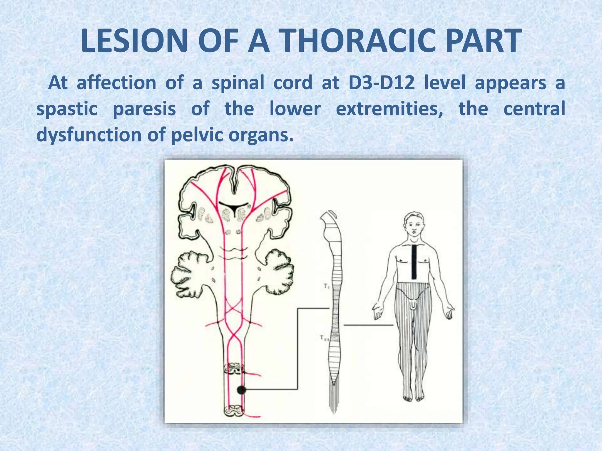 LESION OF A THORACIC PART
At affection of a spinal cord at D3-D12 level appears a
spastic paresis of the lower extremities, the central
dysfunction of pelvic organs.
 