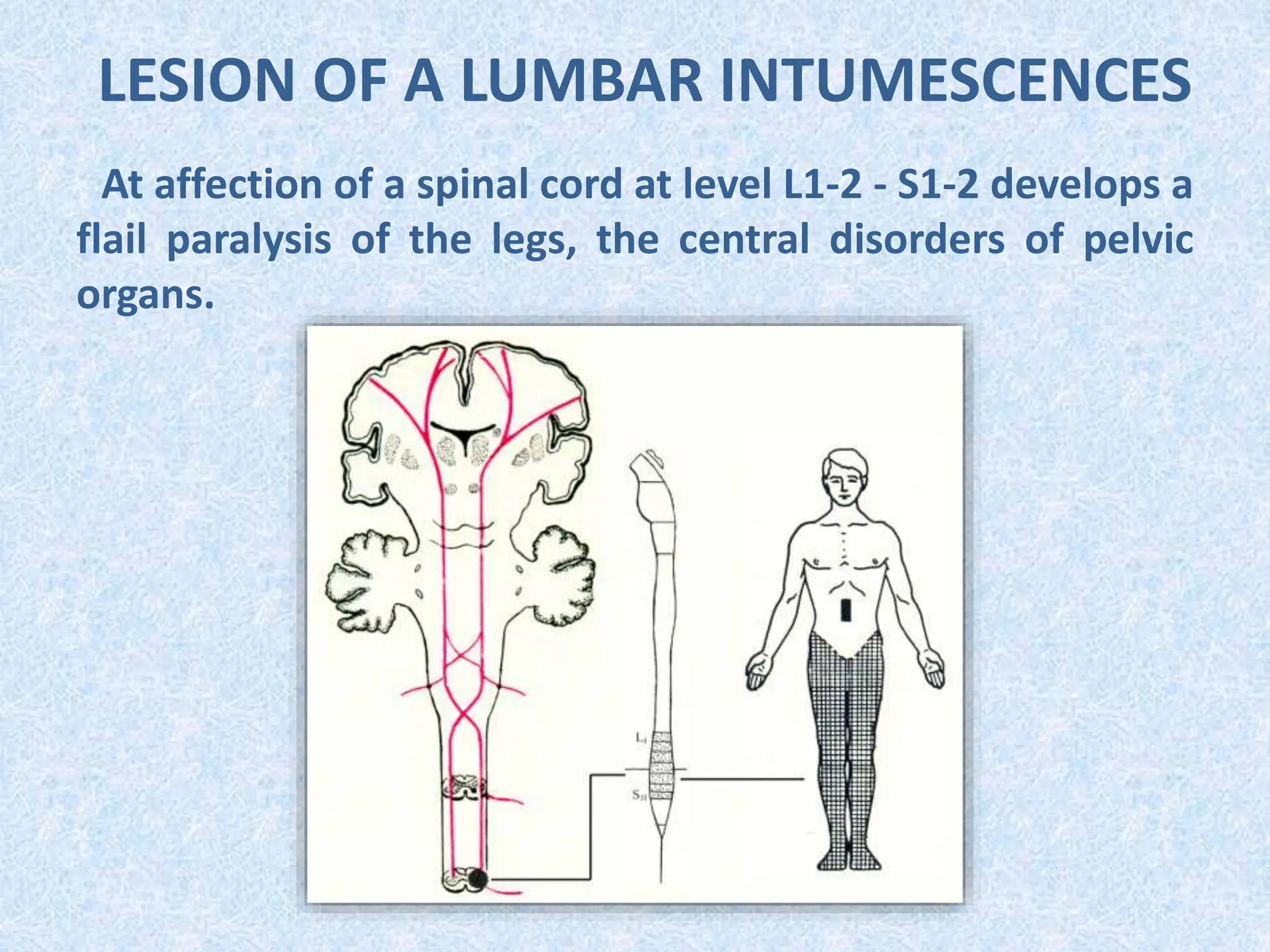 LESION OF A LUMBAR INTUMESCENCES
At affection of a spinal cord at level L1-2 - S1-2 develops a
flail paralysis of the legs, the central disorders of pelvic
organs.
 