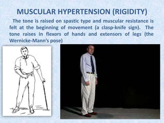 MUSCULAR HYPERTENSION (RIGIDITY)
The tone is raised on spastic type and muscular resistance is
felt at the beginning of movement (a clasp-knife sign). The
tone raises in flexors of hands and extensors of legs (the
Wernicke-Mann’s pose)
 