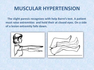 MUSCULAR HYPERTENSION
The slight paresis recognizes with help Barre’s test. A patient
must raise extremities and hold their at closed eyes. On a side
of a lesion extremity falls down.
 