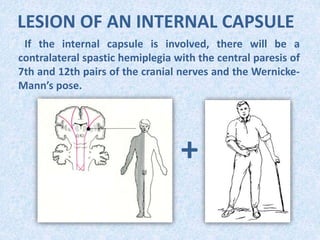 LESION OF AN INTERNAL CAPSULE
If the internal capsule is involved, there will be a
contralateral spastic hemiplegia with the central paresis of
7th and 12th pairs of the cranial nerves and the Wernicke-
Mann’s pose.
+
 