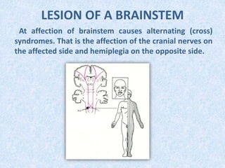 LESION OF A BRAINSTEM
At affection of brainstem causes alternating (cross)
syndromes. That is the affection of the cranial nerves on
the affected side and hemiplegia on the opposite side.
 