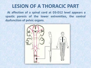 LESION OF A THORACIC PART
At affection of a spinal cord at D3-D12 level appears a
spastic paresis of the lower extremities, the central
dysfunction of pelvic organs.
 