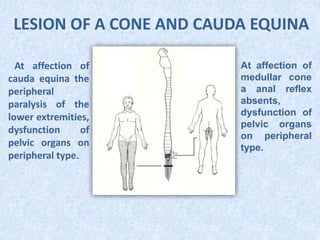 LESION OF A CONE AND CAUDA EQUINA
At affection of
cauda equina the
peripheral
paralysis of the
lower extremities,
dysfunction of
pelvic organs on
peripheral type.
At affection of
medullar cone
a anal reflex
absents,
dysfunction of
pelvic organs
on peripheral
type.
 