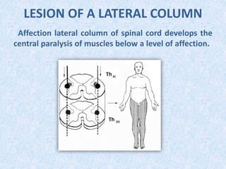 LESION OF A LATERAL COLUMN
Affection lateral column of spinal cord develops the
central paralysis of muscles below a level of affection.
 