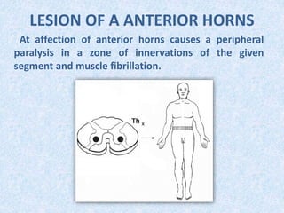 LESION OF A ANTERIOR HORNS
At affection of anterior horns causes a peripheral
paralysis in a zone of innervations of the given
segment and muscle fibrillation.
 