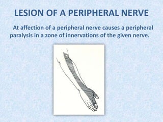 LESION OF A PERIPHERAL NERVE
At affection of a peripheral nerve causes a peripheral
paralysis in a zone of innervations of the given nerve.
 