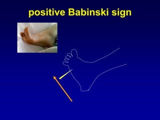 positive Babinski sign
 