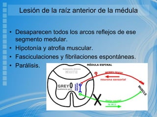 Lesión de la raíz anterior de la médula
• Desaparecen todos los arcos reflejos de ese
segmento medular.
• Hipotonía y atrofia muscular.
• Fasciculaciones y fibrilaciones espontáneas.
• Parálisis.
 