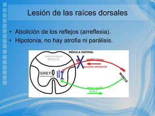 Lesión de las raíces dorsales
• Abolición de los reflejos (arreflexia).
• Hipotonía, no hay atrofia ni parálisis.
 