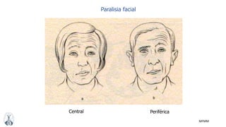 MFMM
Paralisia facial
Central Periférica
 