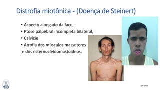 MFMM
Distrofia miotônica - (Doença de Steinert)
• Aspecto alongado da face,
• Ptose palpebral incompleta bilateral,
• Calvície
• Atrofia dos músculos masseteres
e dos esternocleidomastoideos.
 