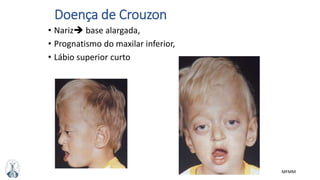 MFMM
Doença de Crouzon
• Nariz base alargada,
• Prognatismo do maxilar inferior,
• Lábio superior curto
 
