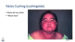 MFMM
Fácies Cushing (cushingoide)
• Fácies de lua cheia
• “Moon face”
 