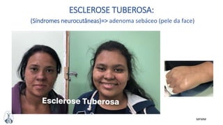 MFMM
ESCLEROSE TUBEROSA:
(Síndromes neurocutâneas)=> adenoma sebáceo (pele da face)
 