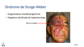MFMM
Síndrome de Sturge-Weber
• Angiomatose encefalotrigeminal
• Angioma calcificado de leptomeninge
NEVUS FLAMEO
 
