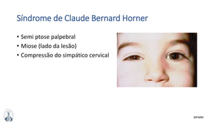 MFMM
Síndrome de Claude Bernard Horner
• Semi ptose palpebral
• Miose (lado da lesão)
• Compressão do simpático cervical
 