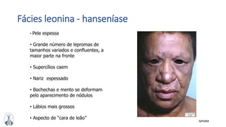 MFMM
Fácies leonina - hanseníase
• Pele espessa
• Grande número de lepromas de
tamanhos variados e confluentes, a
maior parte na fronte
• Supercílios caem
• Nariz espessado
• Bochechas e mento se deformam
pelo aparecimento de nódulos
• Lábios mais grossos
• Aspecto de “cara de leão”
 