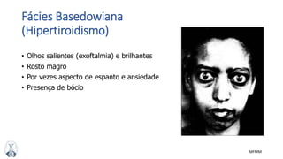 MFMM
Fácies Basedowiana
(Hipertiroidismo)
• Olhos salientes (exoftalmia) e brilhantes
• Rosto magro
• Por vezes aspecto de espanto e ansiedade
• Presença de bócio
 