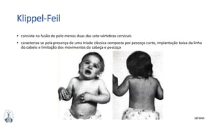 MFMM
Klippel-Feil
• consiste na fusão de pelo menos duas das sete vértebras cervicais
• caracteriza-se pela presença de uma tríade clássica composta por pescoço curto, implantação baixa da linha
do cabelo e limitação dos movimentos da cabeça e pescoço
 