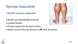 MFMM
Doenças musculares
• Distrofia muscular progressiva:
Atrofia com distribuição proximal,
Lordose lombar,
Pseudo-hipertrofia das panturrilhas,
Modo característico de levantar-se Sinal de Gowers.
 