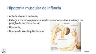MFMM
Hipotonia muscular da infância
• Atitude=boneca de trapo,
• Cabeça e membros pendem inertes quando se eleva a criança na
posição de decúbito dorsal,
• Hipotonia,
• Doença de Werding-Hoffmann
 