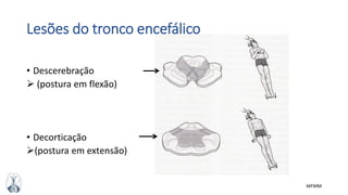 MFMM
Lesões do tronco encefálico
• Descerebração
 (postura em flexão)
• Decorticação
(postura em extensão)
 