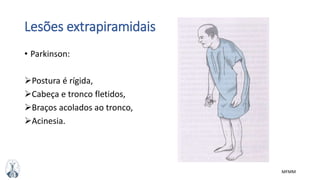 MFMM
Lesões extrapiramidais
• Parkinson:
Postura é rígida,
Cabeça e tronco fletidos,
Braços acolados ao tronco,
Acinesia.
 