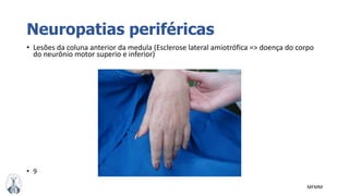 MFMM
Neuropatias periféricas
• Lesões da coluna anterior da medula (Esclerose lateral amiotrófica => doença do corpo
do neurônio motor superio e inferior)
• 9
 