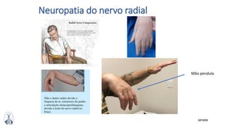 MFMM
Neuropatia do nervo radial
Mão pendula
 