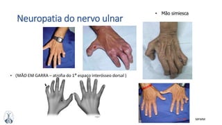 MFMM
Neuropatia do nervo ulnar
• (MÃO EM GARRA – atrofia do 1° espaço interósseo dorsal )
• Mão simiesca
 