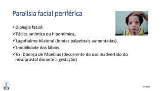MFMM
Paralisia facial periférica
• Diplegia facial:
Fácies amímica ou hipomímica,
Lagoftalmo bilateral (fendas palpebrais aumentadas),
Imobilidade dos lábios.
Ex: Doença de Moebius (decorrente do uso inadvertido do
misoprostol durante a gestação)
 