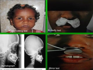 Butterfly test
Mirror test
Water holding test
cephalograph
 