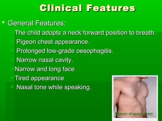 Clinical FeaturesClinical Features
 General Features:General Features:
The child adopts a neck forward position to breath.The child adopts a neck forward position to breath.
 Pigeon chest appearance.Pigeon chest appearance.
 Prolonged low-grade oesophagitis.Prolonged low-grade oesophagitis.
 Narrow nasal cavity.Narrow nasal cavity.
Narrow and long faceNarrow and long face
Tired appearanceTired appearance
 Nasal tone while speaking.Nasal tone while speaking.
Pigeon shaped chest
 