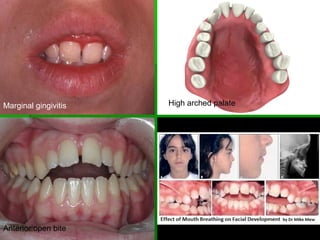 Marginal gingivitis High arched palate
Anterior open bite
 