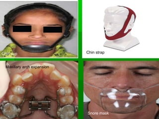 Chin cup Chin strap
Maxillary arch expansion
Snore mask
 