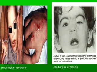 Lesch-Nyhan syndrome De Lange’s syndrome
 