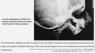 Mouth breathing habit pathophysiology and treament.pptx