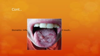 Cont..
Stomatitis: Inflammation of the mucous membrane of mouth.
 