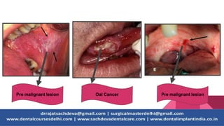Pre malignant lesion Pre malignant lesionOal Cancer
 